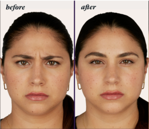 botox-3-e1638867262212